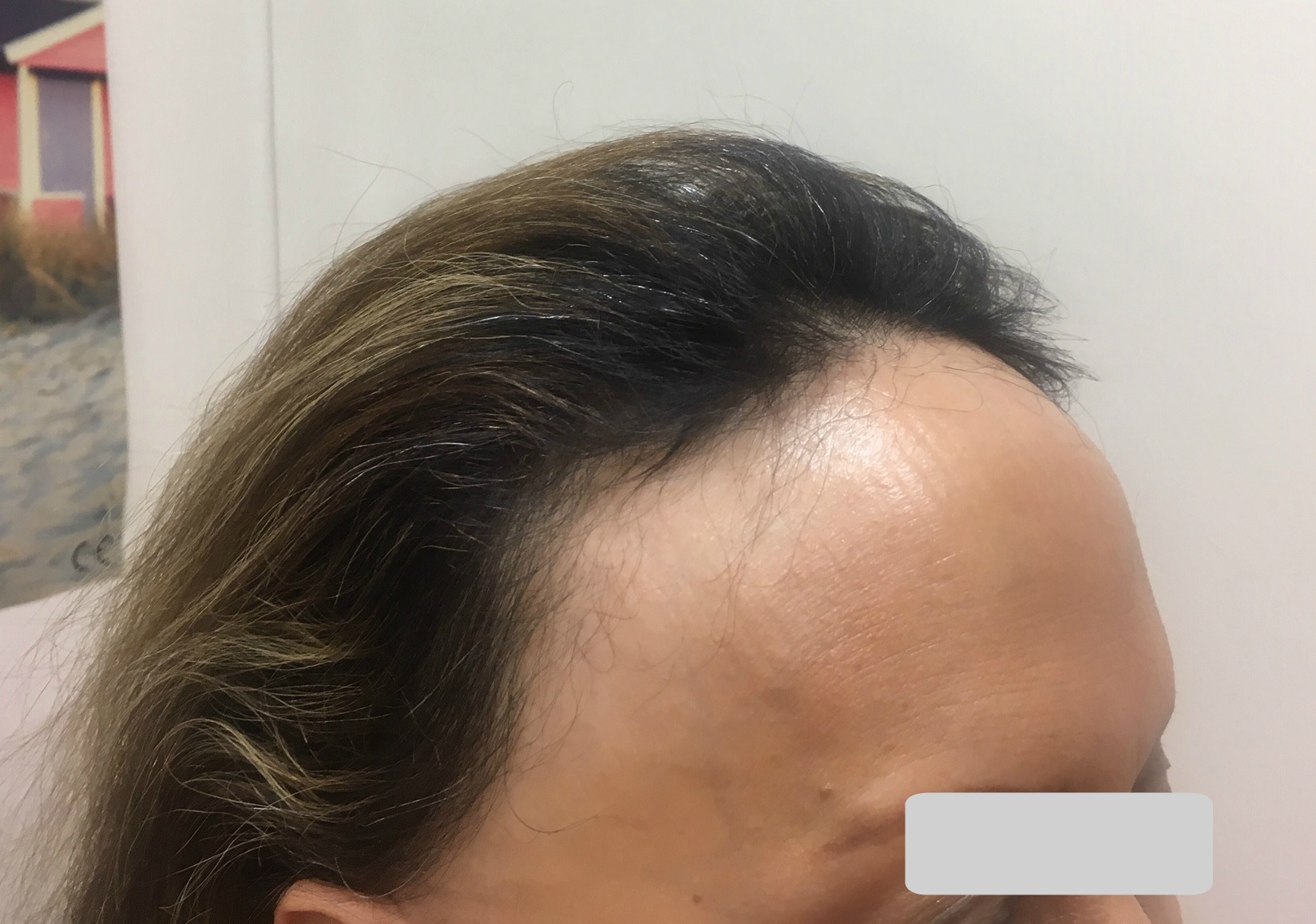 alopecia de payaso - PRÓTESIS CAPILARES FIJAS HOMBRE-MUJER