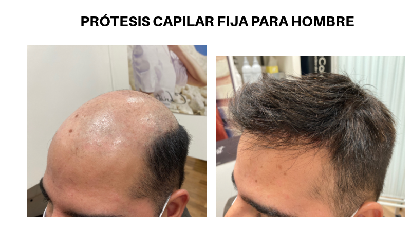 protesis capilar fija hombre - PRÓTESIS CAPILARES FIJAS HOMBRE-MUJER