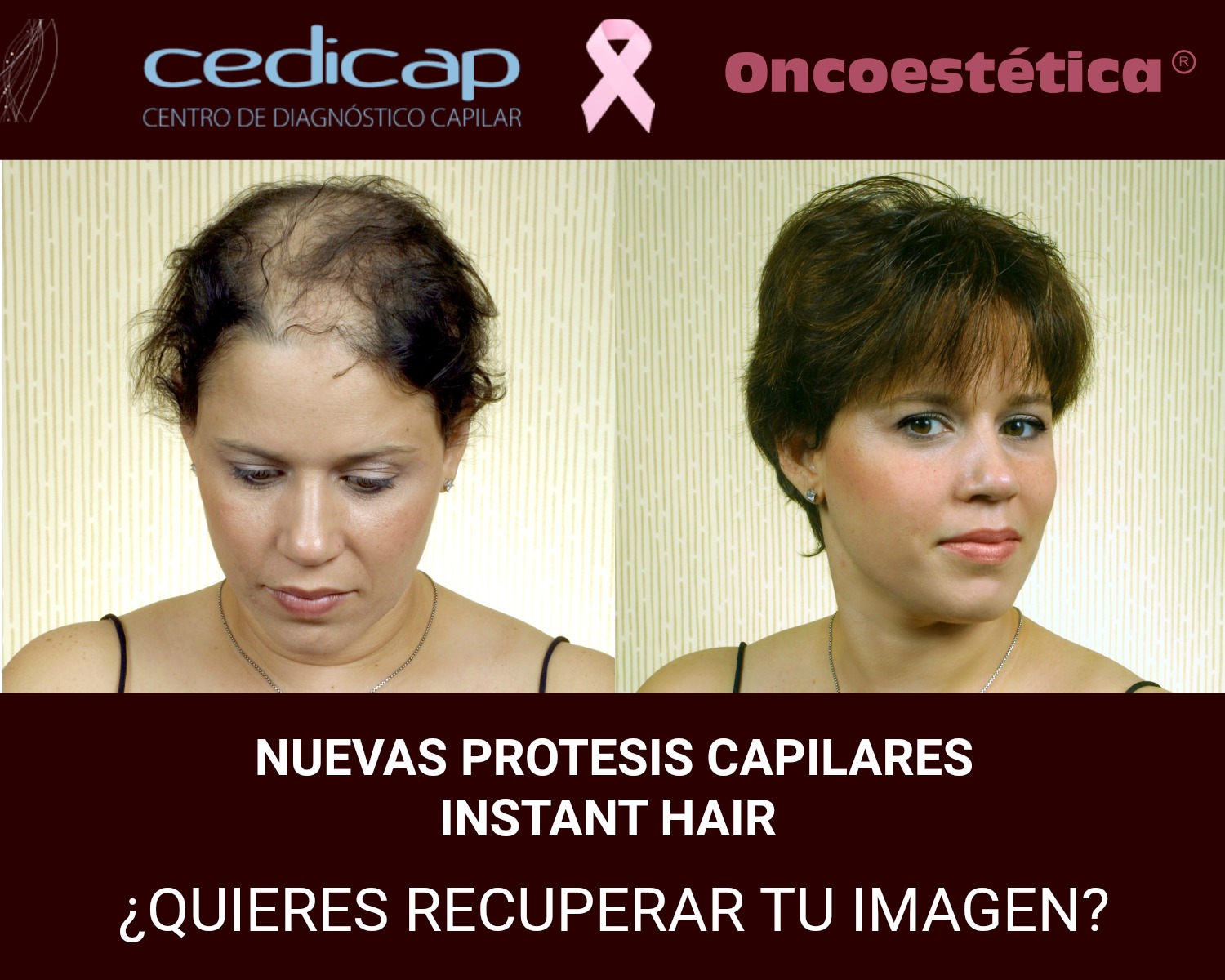 protesis capilares solucion alopecia - PRÓTESIS CAPILARES FIJAS HOMBRE-MUJER