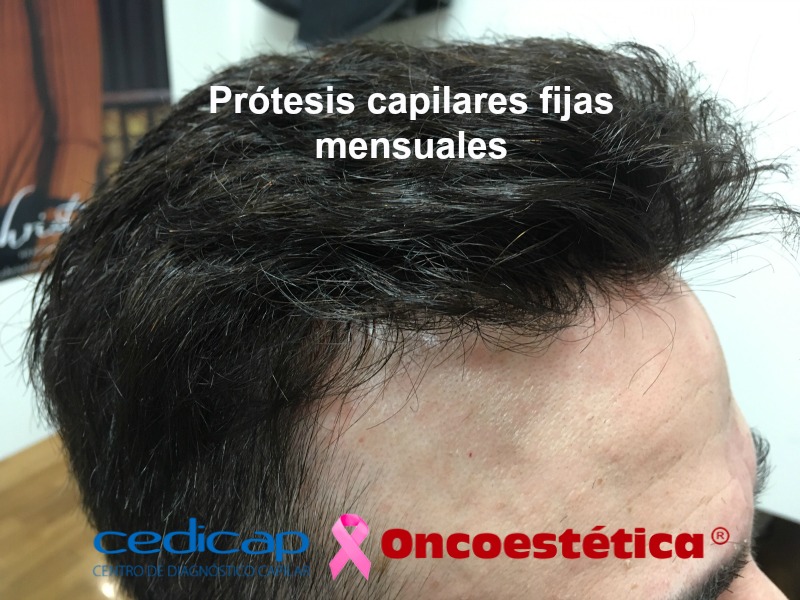 protesis pelo hombre - PRÓTESIS CAPILARES FIJAS HOMBRE-MUJER
