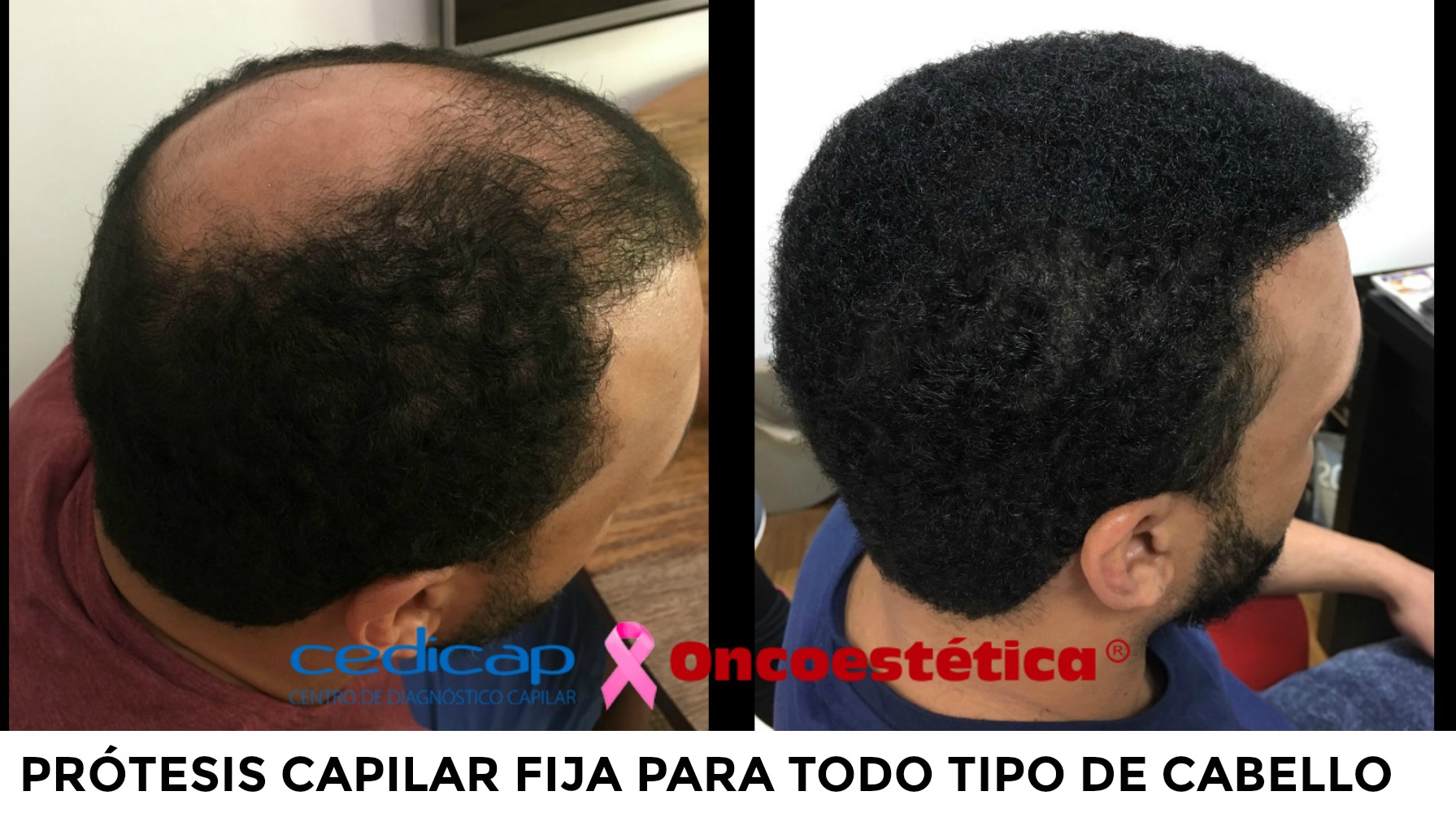 solucion alopecia protesis fija hombre - PRÓTESIS CAPILARES FIJAS HOMBRE-MUJER