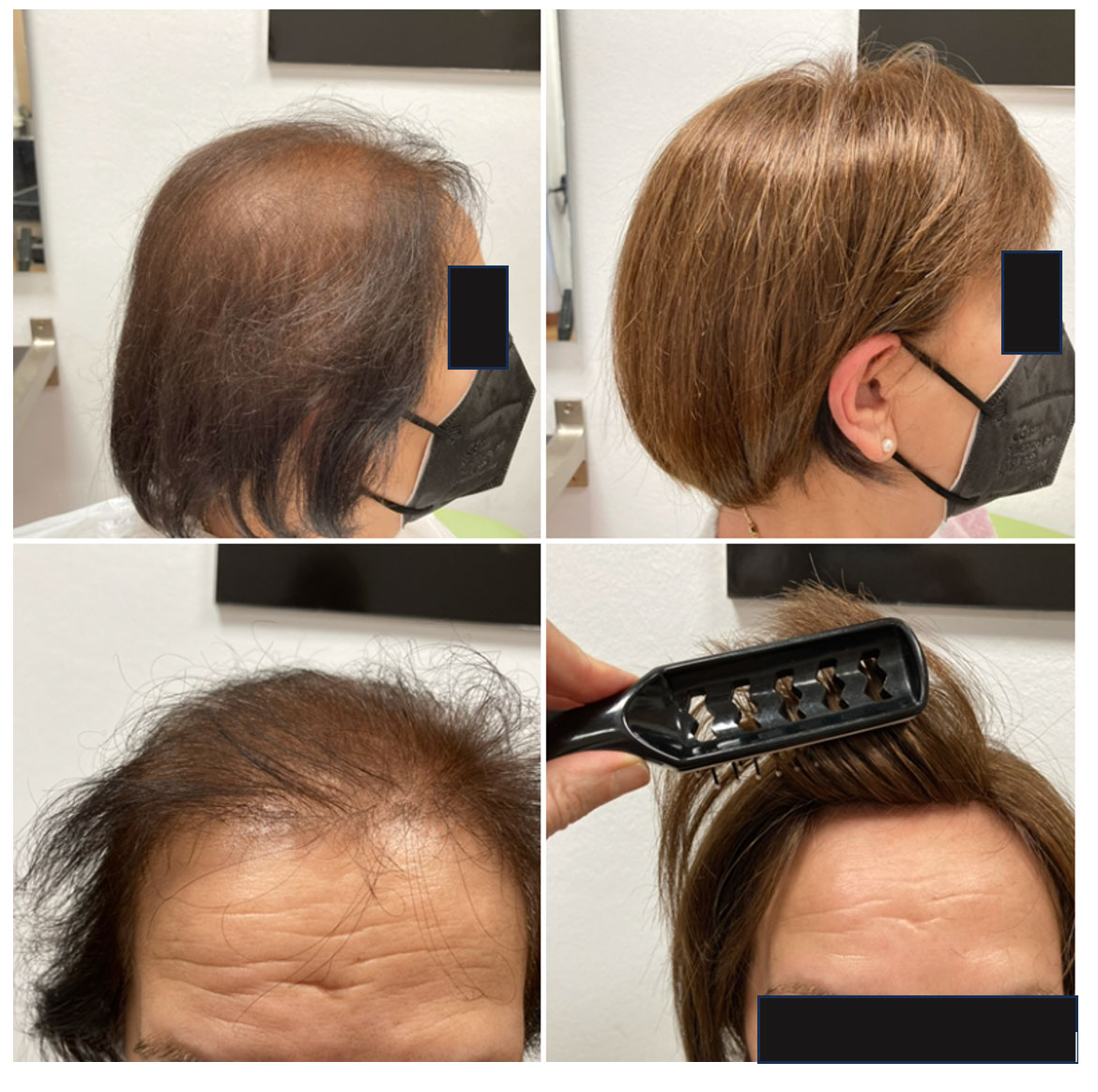 alopecia difusa femenina pelucas zaragoza - PRÓTESIS CAPILARES FIJAS HOMBRE-MUJER