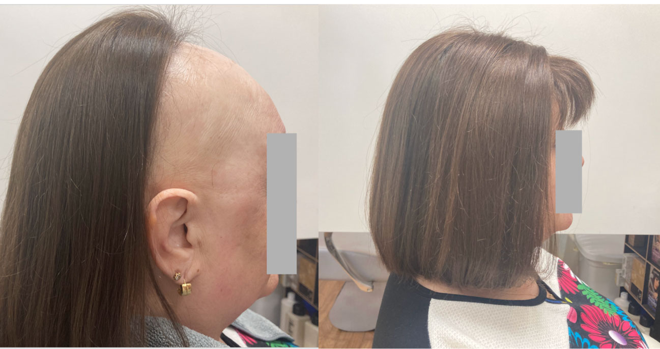 alopecia frontal fibrosante 1 - Alopecia Frontal Fibrosante