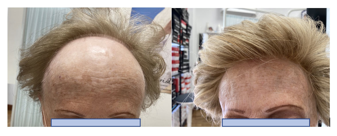 alopecia frontal fibrosante 3 - Alopecia Frontal Fibrosante
