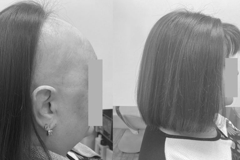 alopecia frontal fibrosante destacada - inicio